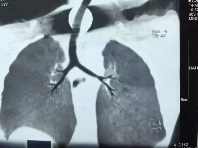 男童感觉嗓子有异物感怎么回事,7岁儿童喉咙发出咯咯声