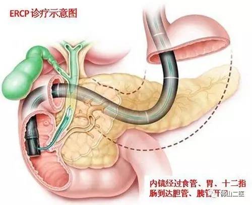 胆道感染引起的发烧怎么办,胆道感染发烧怎么治疗