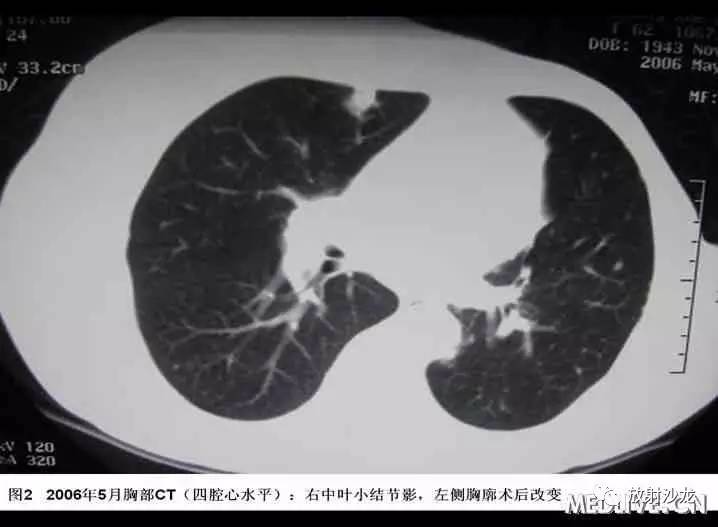 双肺实性小结节考虑炎症肉芽肿,双肺多发恶性肺结节100多个