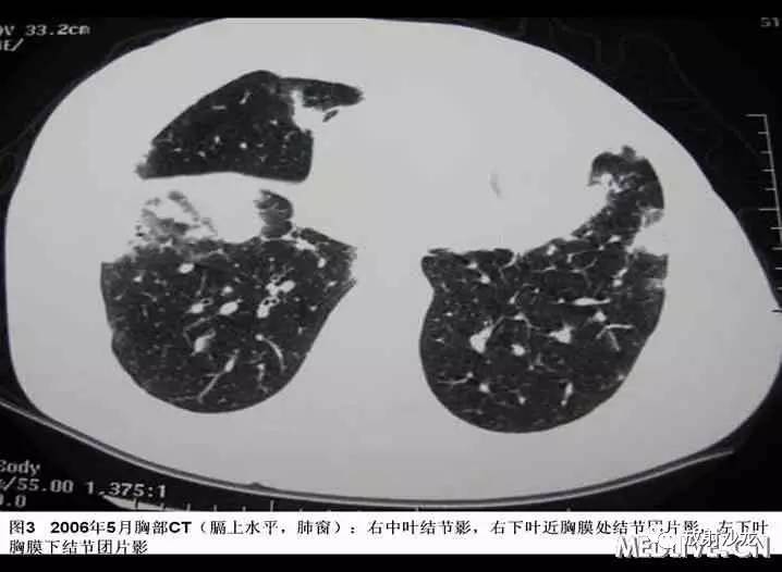 双肺实性小结节考虑炎症肉芽肿,双肺多发恶性肺结节100多个