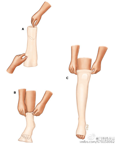 静脉曲张引发溃疡怎么治疗,如何治疗静脉曲张引起的溃疡