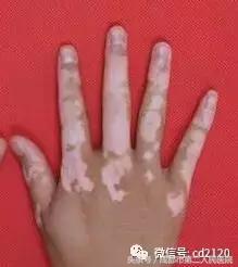 皮肤科梁万岗医生专治白癜风,皮肤科的医生有患白癜风吗