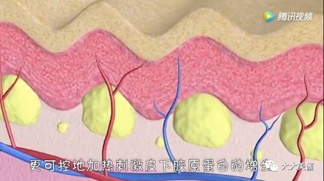 视频｜还没到30，皮肤松弛了？不开刀也不疼的射频提升？
