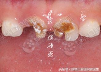 乳前牙透明冠修复视频,乳前牙残根修复