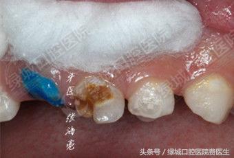 乳前牙透明冠修复视频,乳前牙残根修复