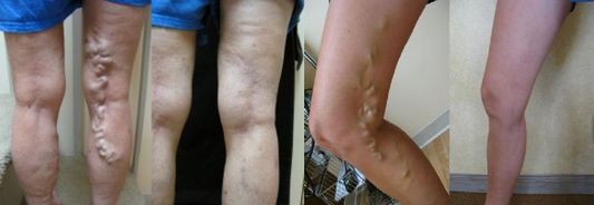 静脉曲张怎样预防并发症,鱼肝油酸钠治疗静脉曲张并发症