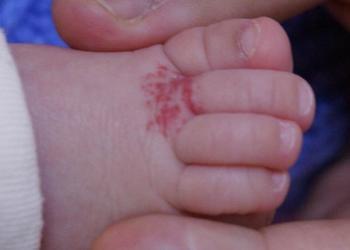 小孩身上有红斑是不是血管瘤,婴儿面部红斑痣与血管瘤怎么判断