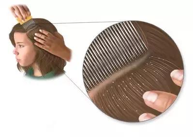 小孩头皮屑超级多是长虱子了吗,头虱和头皮屑的区别症状和表现