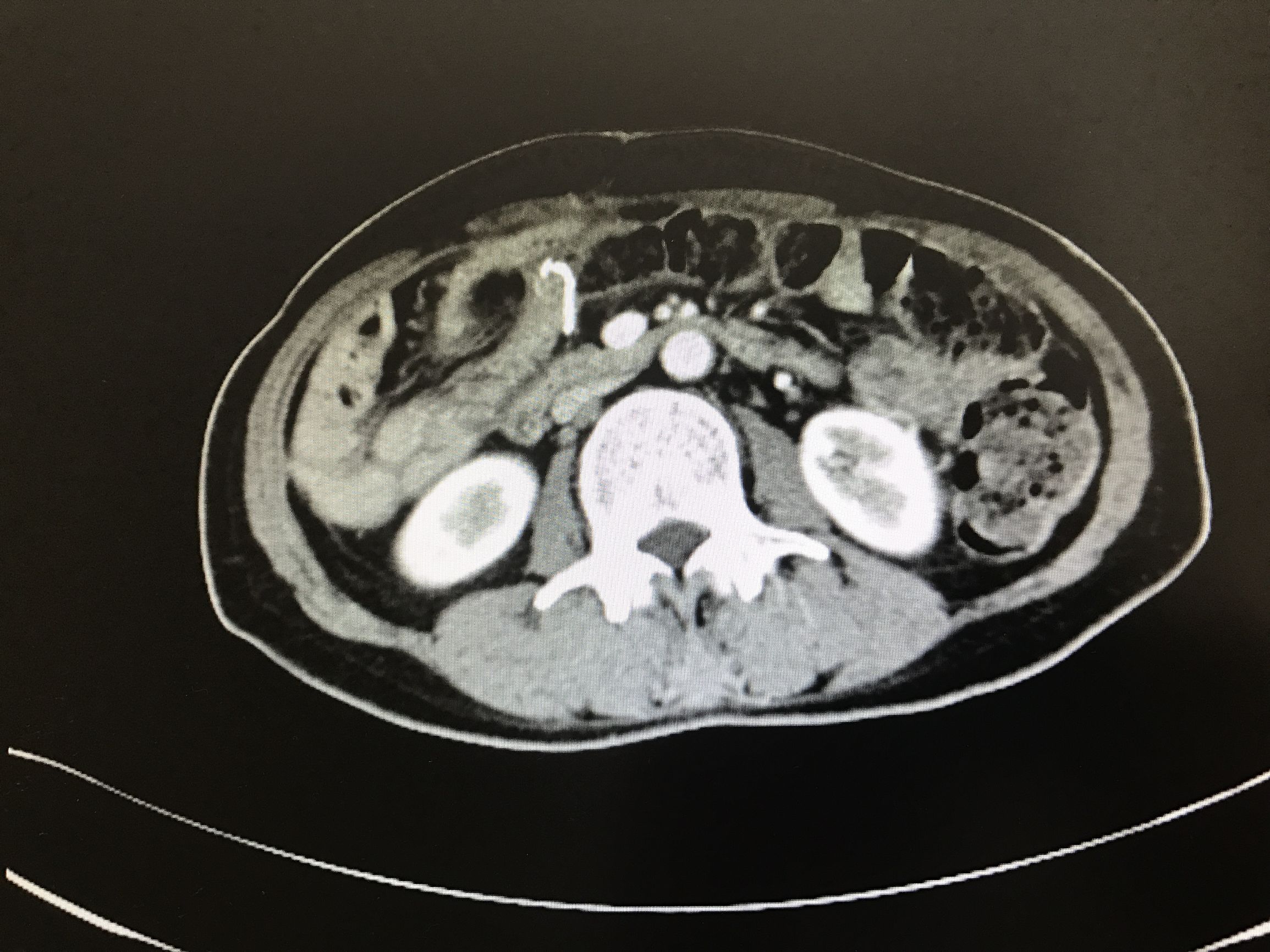 阑尾癌是什么,阑尾癌切除右半结肠