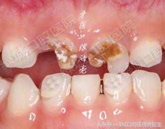 乳前牙透明冠修复视频,乳前牙残根修复