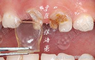 乳前牙透明冠修复视频,乳前牙残根修复