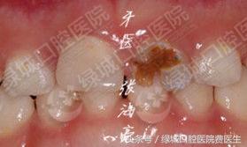 乳前牙透明冠修复视频,乳前牙残根修复