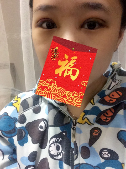 全切双眼皮20天了还一大一小,全切双眼皮的第二个月不来大姨妈