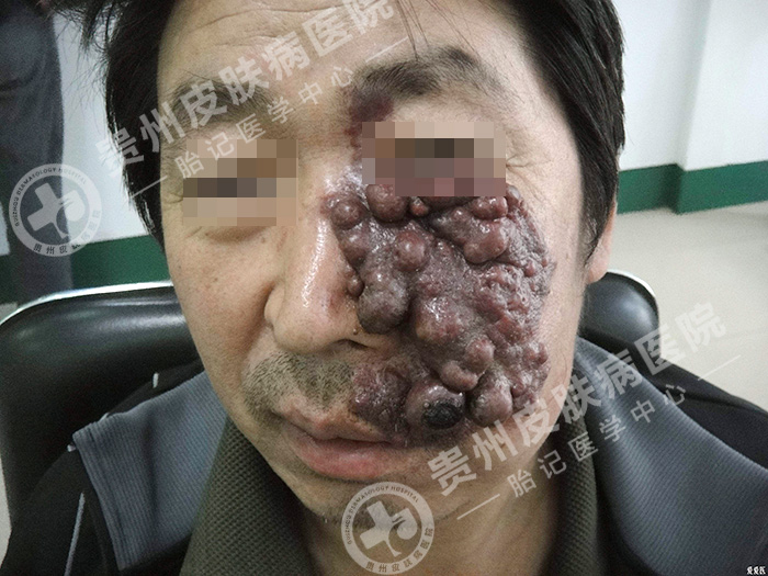 中老年胎记还能治好吗？