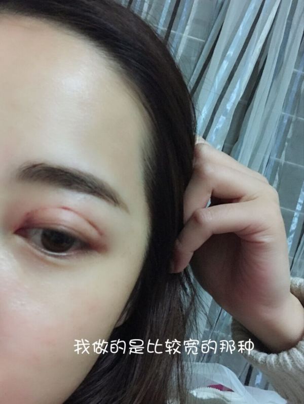 鼓起勇气做了个双眼皮,鼓起勇气做了医美