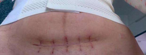 一层层，一刀刀切开孕妇肚子，剖腹产并不是你想象的那么简单