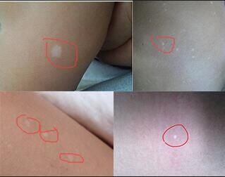 白癜风早期会有小米粒疙瘩吗,儿童白癜风早期治愈率90%