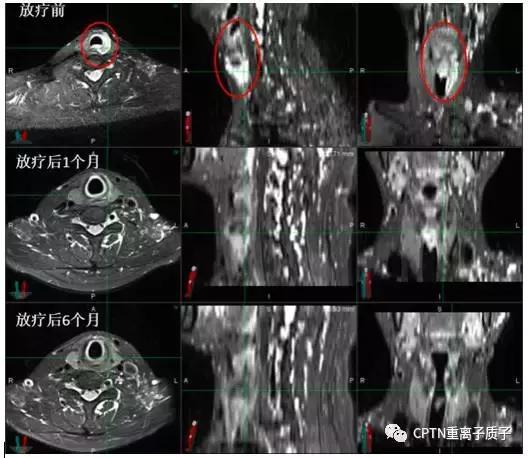 目前质子重离子治疗,2020年中国质子重离子有哪些医院