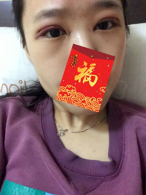 全切双眼皮20天了还一大一小,全切双眼皮的第二个月不来大姨妈