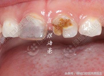 乳前牙透明冠修复视频,乳前牙残根修复