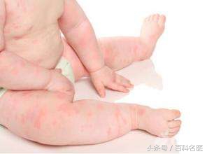 奶粉过敏要吃多久的适度水解奶粉,奶粉抗过敏的有哪些