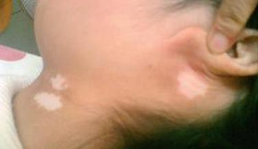 准妈妈实用技能：如何判断宝宝得了蛔虫病附治疗方式