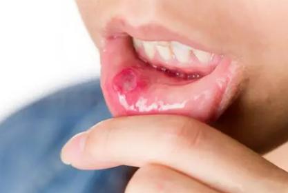 口腔溃疡缺乏维生素什么,口腔溃疡预防吃什么维生素