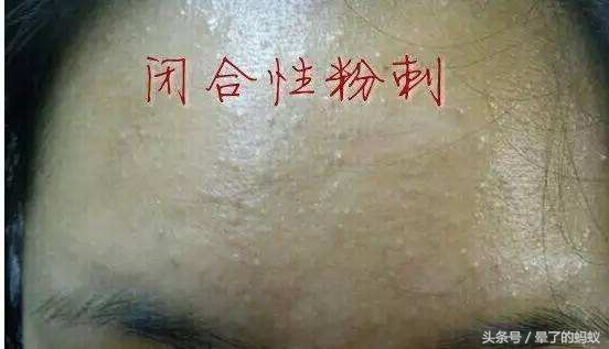 脸上的黑头粉刺怎么去除最有效,去除脸上粉刺和油的最好方法