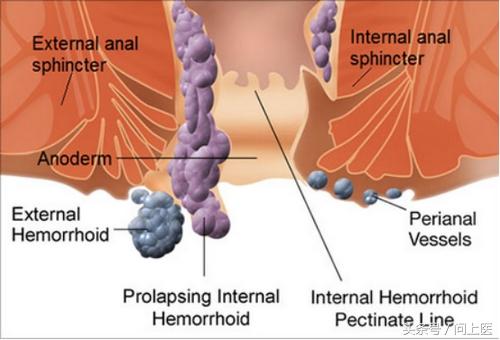 痔疮不管它有什么后果,痔疮患者需要了解的事