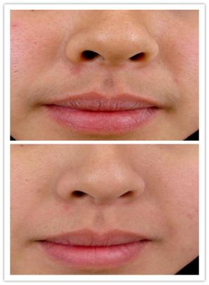 脱毛的十大误区,脱毛有50年历史吗