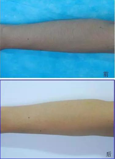 脱毛的十大误区,脱毛有50年历史吗