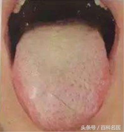 舌苔变黑是得了重病吗,舌苔发黑是大病预兆吗