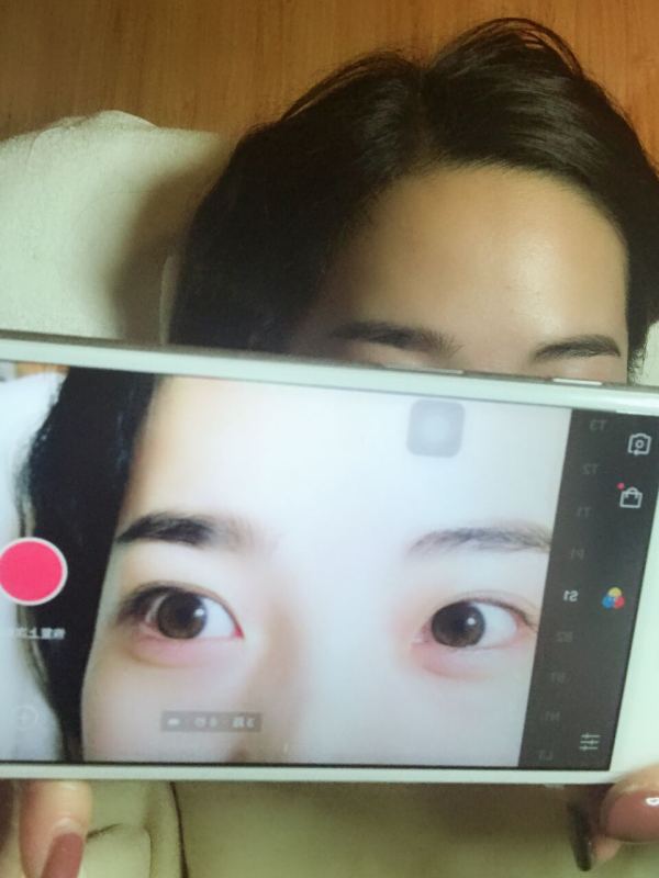 鼓起勇气做了个双眼皮,鼓起勇气做了医美