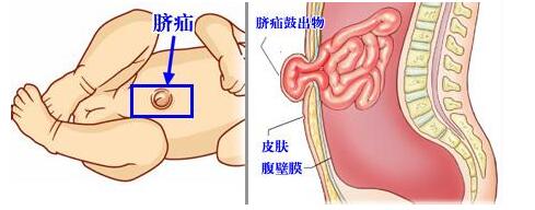 新生儿脐疝怎么护理,小儿脐疝脐带四周会鼓起吗