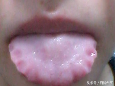 舌苔变黑是得了重病吗,舌苔发黑是大病预兆吗