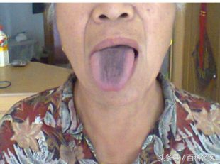 舌苔变黑是得了重病吗,舌苔发黑是大病预兆吗
