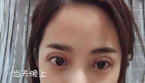 鼓起勇气做了个双眼皮,鼓起勇气做了医美