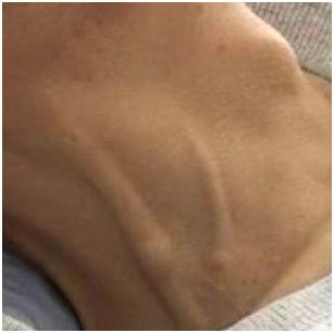 皮肤出现瘀斑是肝癌吗,皮肤出现小黑点是什么癌症