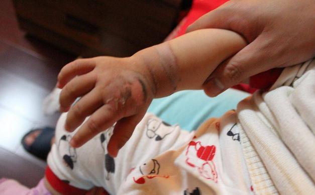 一岁多宝宝烫伤用什么中药,一岁宝宝稀饭烫伤