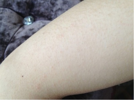 皮肤鸡皮疙瘩怎么快速解决,皮肤的鸡皮疙瘩