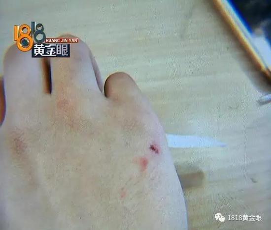 女子保护4岁女孩被斗牛犬咬伤,女子被斗牛犬咬伤