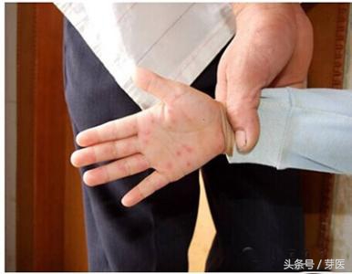 手足口引起的指甲脱落图片,孩子手足口半年了指甲还是烂