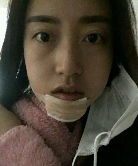 下巴后缩垫下巴案例,垫了下巴膨体皮肤松弛严重