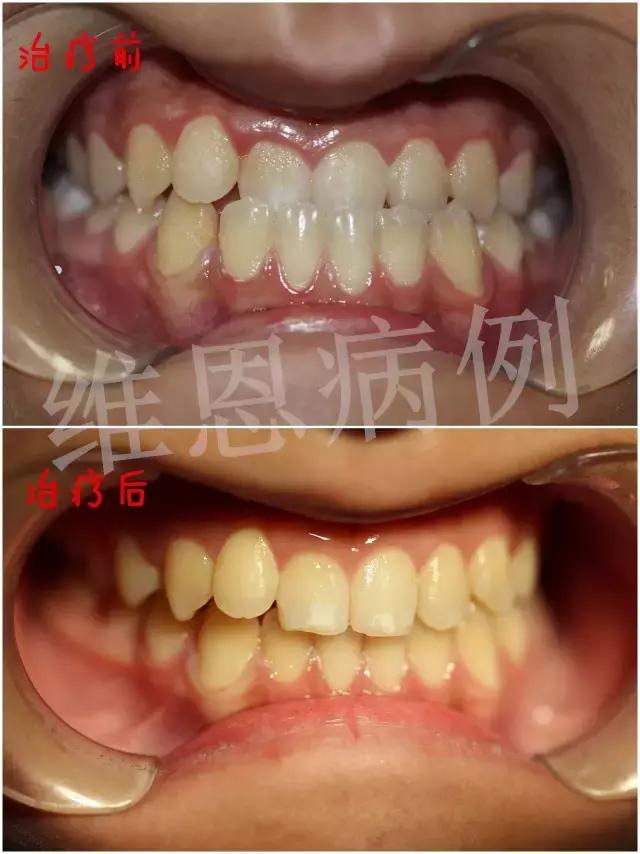 小孩牙齿反颌治疗方案,儿童牙齿反颌矫正要多少钱