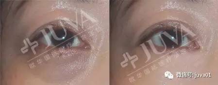 你的黑眼圈怎么去的,4招教你缓解黑眼圈远离熊猫眼