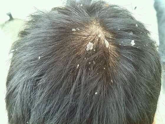 头皮屑到底是什么啊,原来头皮屑是怎么来的