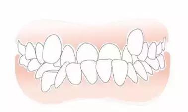 小孩牙齿反颌治疗方案,儿童牙齿反颌矫正要多少钱