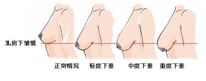 哺乳后如何预防乳房下垂,哺乳后乳房下垂中医如何调理保养