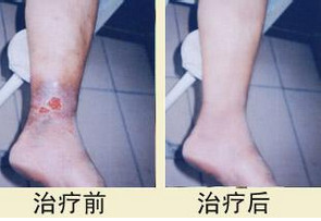 老烂腿治好后图片,得了老烂腿如何治疗
