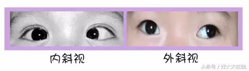 怎么辨别孩子是不是对眼,孩子是不是对眼